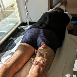 Cupping, detoxify, tissue release and drainage. demonstrating the use of cupping on a leg.